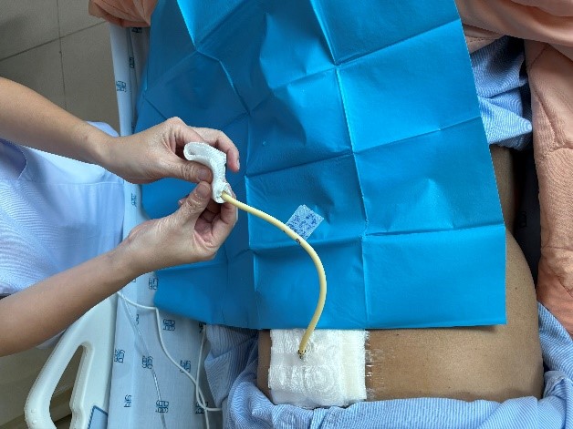 che chở đầu OMTDd bằng gạc bước 6.jpg